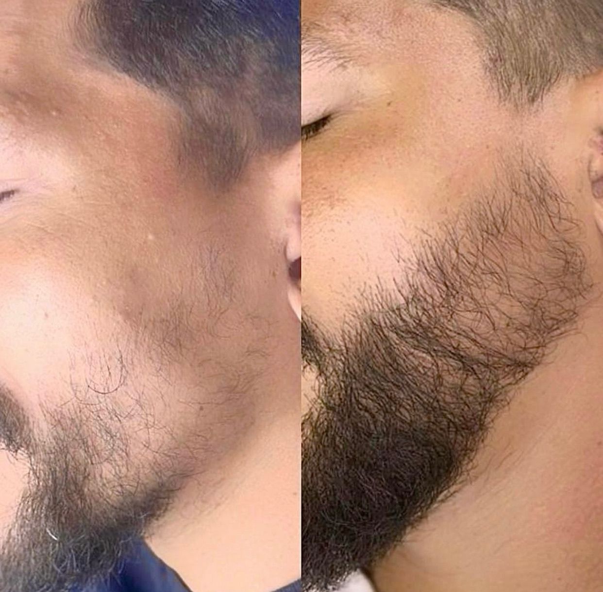 Segundo registro autorizado de acompanhamento de falhas na barba